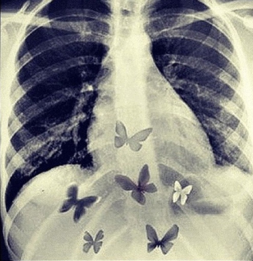 Бабочки в моем животе это любовь. Бабочки в животе. Бабочки в животе рентген. Бабочки в легких рентген. Снимок легких с бабочками.